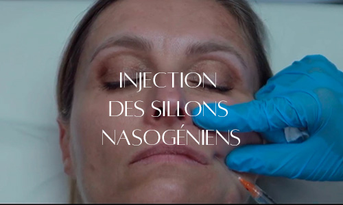 Injection dans les sillons nasogéniens pour lisser les plis et rajeunir l'apparence du bas du visage.