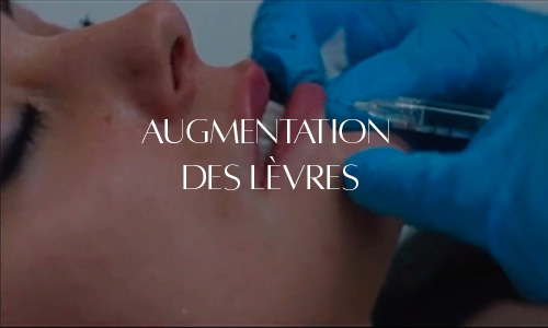 Injection d'acide hyaluronique pour l'augmentation des lèvres, mettant en avant la précision et la délicatesse du geste médical.