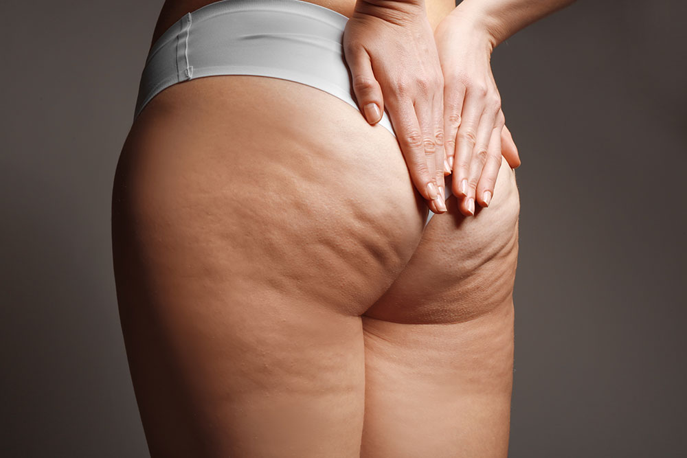 cellulite peau orange