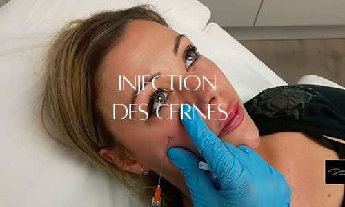 Injection d'acide hyaluronique sous les yeux pour traiter les cernes et restaurer le volume perdu pour defatiguer le regard