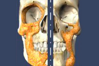 Schéma comparatif montrant la distribution et la perte de graisse faciale avec l'âge, affectant la structure et les contours du visage.