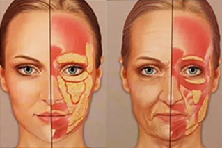 Illustration comparant un visage jeune et un visage âgé, montrant le relâchement des muscles et la perte de volume facial au fil du temps.