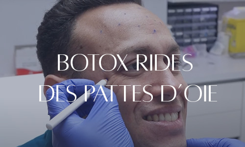 Injection de botox pour traiter les rides des pattes d'oie d'un patient, avec un médecin en action