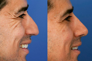 Avant et après correction d'une pointe de nez tombante grâce à une rhinoplastie médicale pour relever le bout du nez et harmoniser le profil.