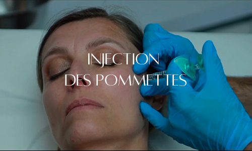 Injection d'acide hyaluronique dans les pommettes pour restaurer le volume et améliorer l'harmonie du visage.